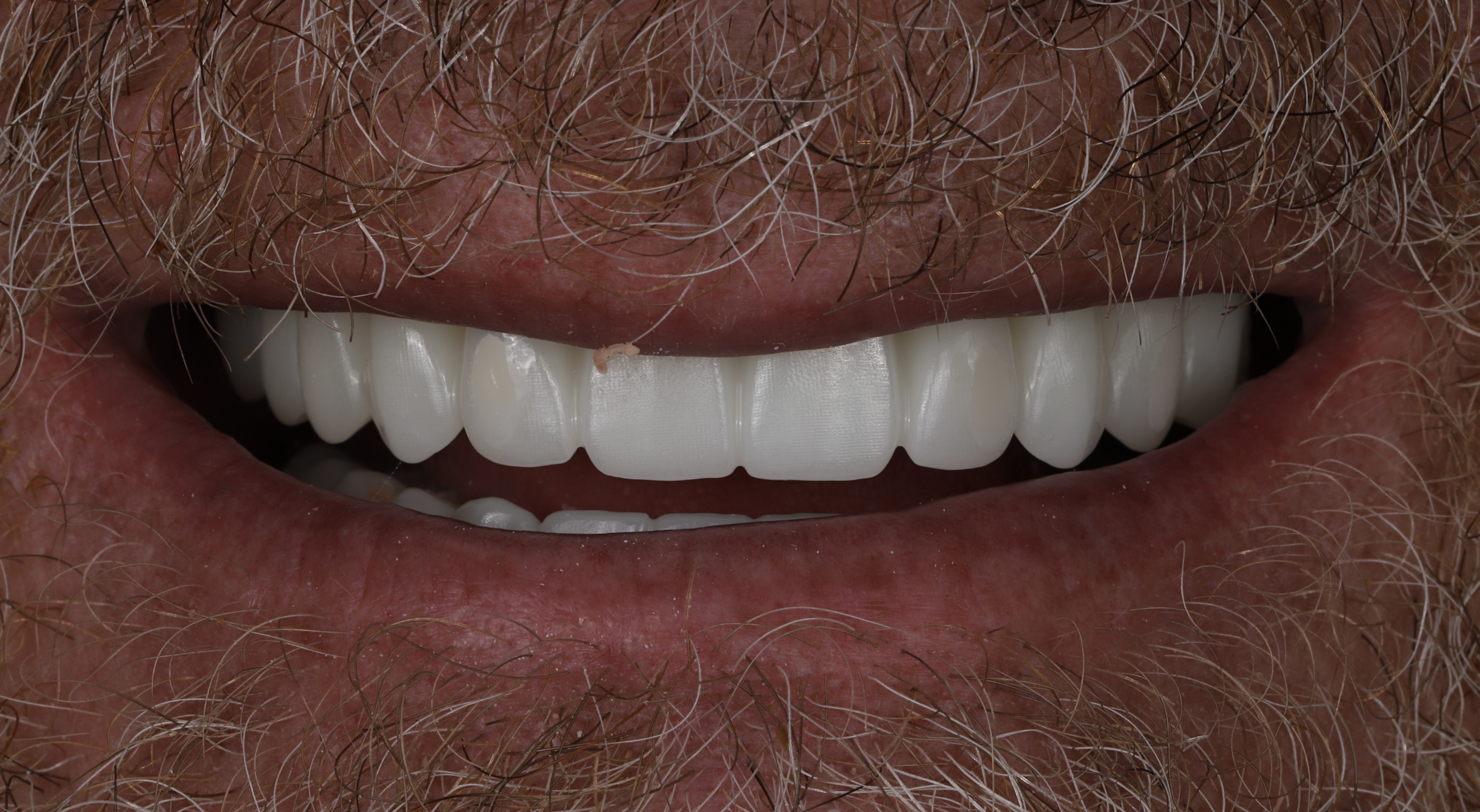 Full arch implant result — patient smile